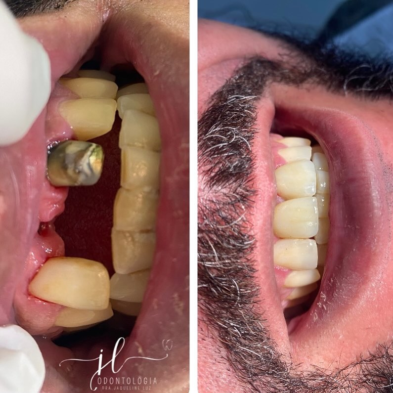 Implante e Coroa — antes e depois